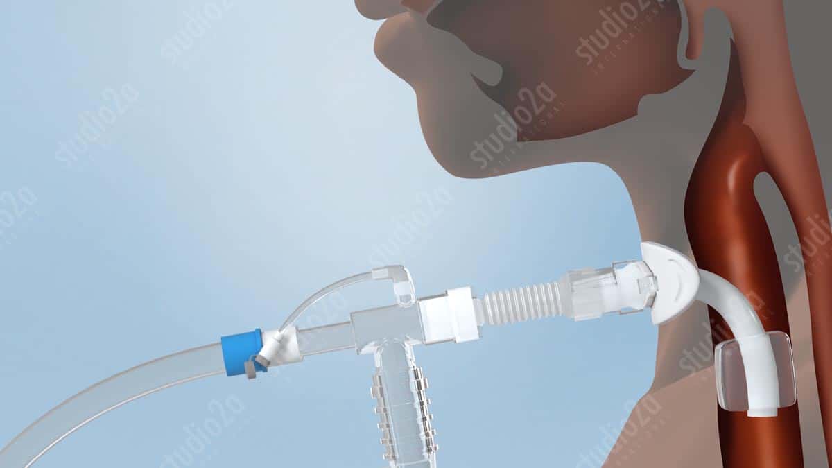 INNER CANNULA